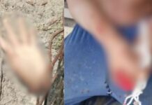 IMAGENS FORTES: Homem chega a hospital de Maués com mão decepada e ferimentos graves