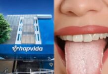 Hapvida alerta: língua branca pode indicar problemas de higiene e até doenças; veja cuidados no Carnaval