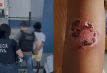Pai é preso acusado de agredir e queimar filhos na zona norte de Manaus